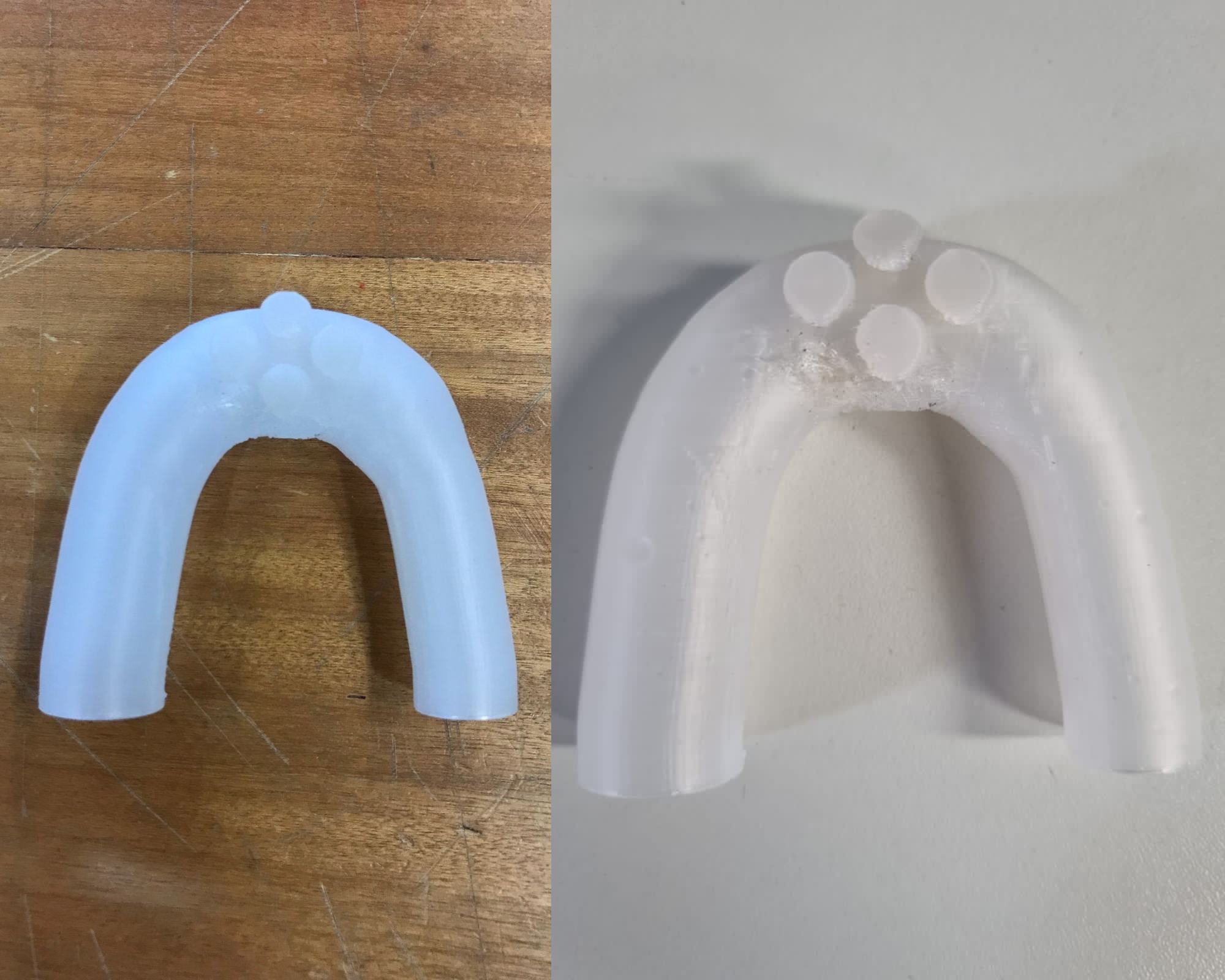 Prótese feita em impressora 3D é mais uma opção no tratamento de fístulas e defeitos de parede do trato gastrointestinal